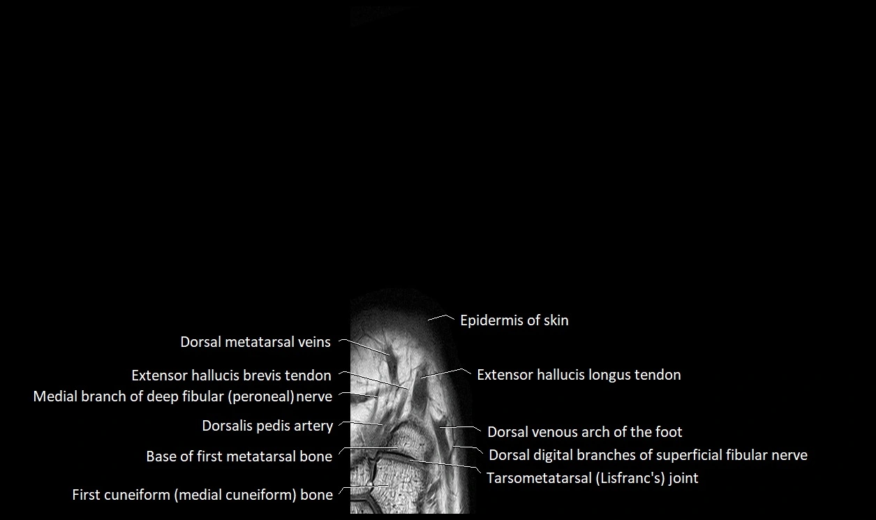 Great Toe micro anatomy MRI axial cross sectional 3T image 5.webp